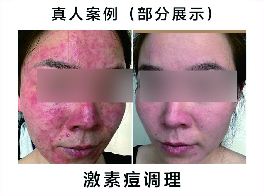除痘淨膚真人案例對比