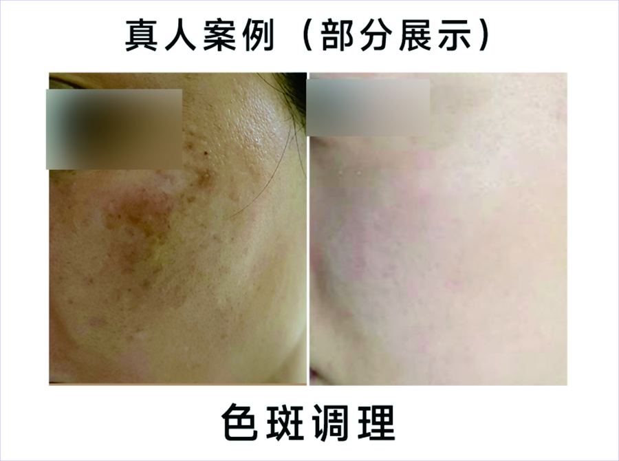 祛斑美白真人案例對比